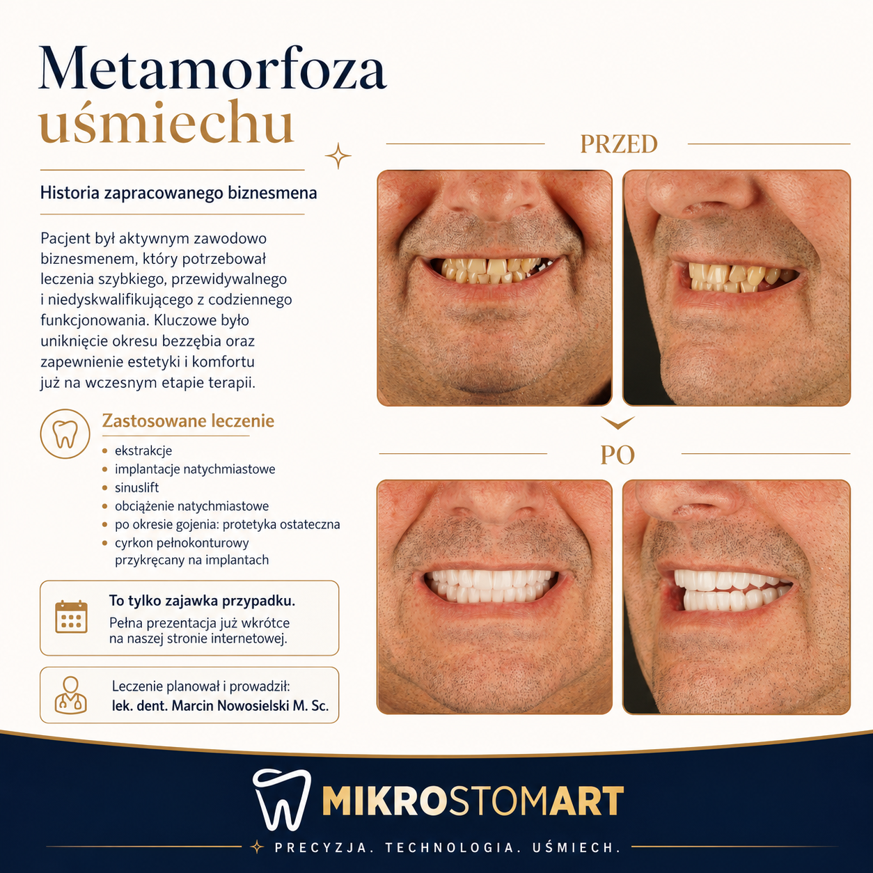 Pełna rekonstrukcja na implantach — dokumentacja przed/po, Mikrostomart Opole